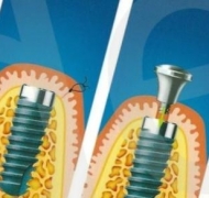 Могут ли зубные имплантаты стать «родными»?